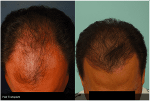 The Facts about Hair Loss - Frank Agullo, MD