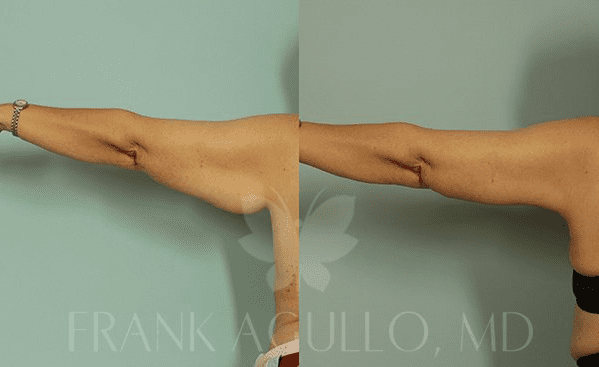 Exercises to tone flabby arms