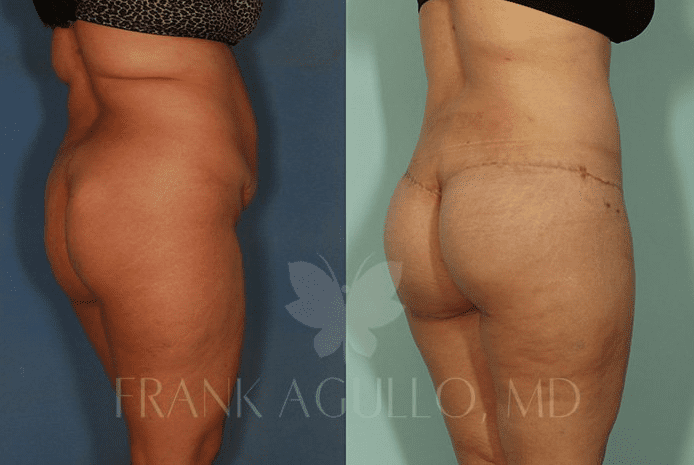 Supercharged BBL (Butt Fat Transfer With Butt Implants) - El Paso, TX -  Frank Agullo, MD