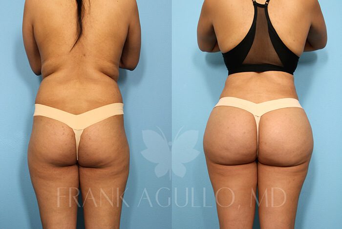Before & After Photos  Brazilian Butt Lift Patient 62 - Frank
