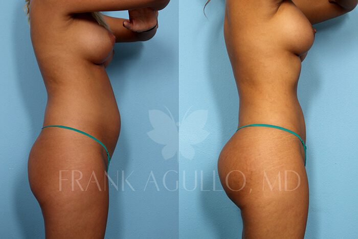 Before & After Photos  Brazilian Butt Lift Patient 87 - Frank Agullo, MD