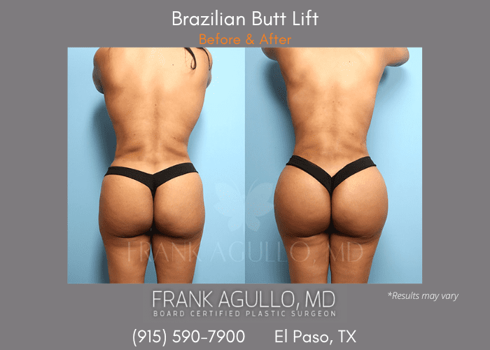 Supercharged BBL (Butt Fat Transfer With Butt Implants) - El Paso, TX -  Frank Agullo, MD