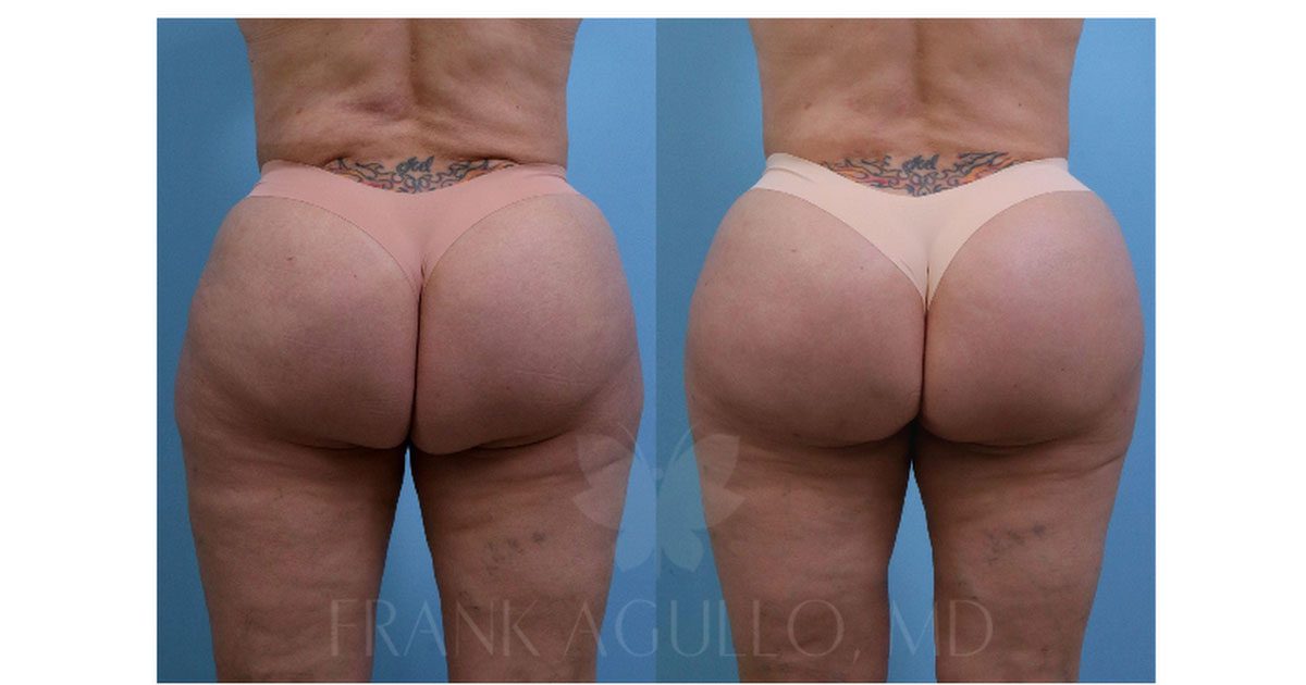 THE MIAMI LIFT: A REVOLUTIONARY SOLUTION TO THE DOUBLE BUTT DILEMMA -  Frank Agullo, MD