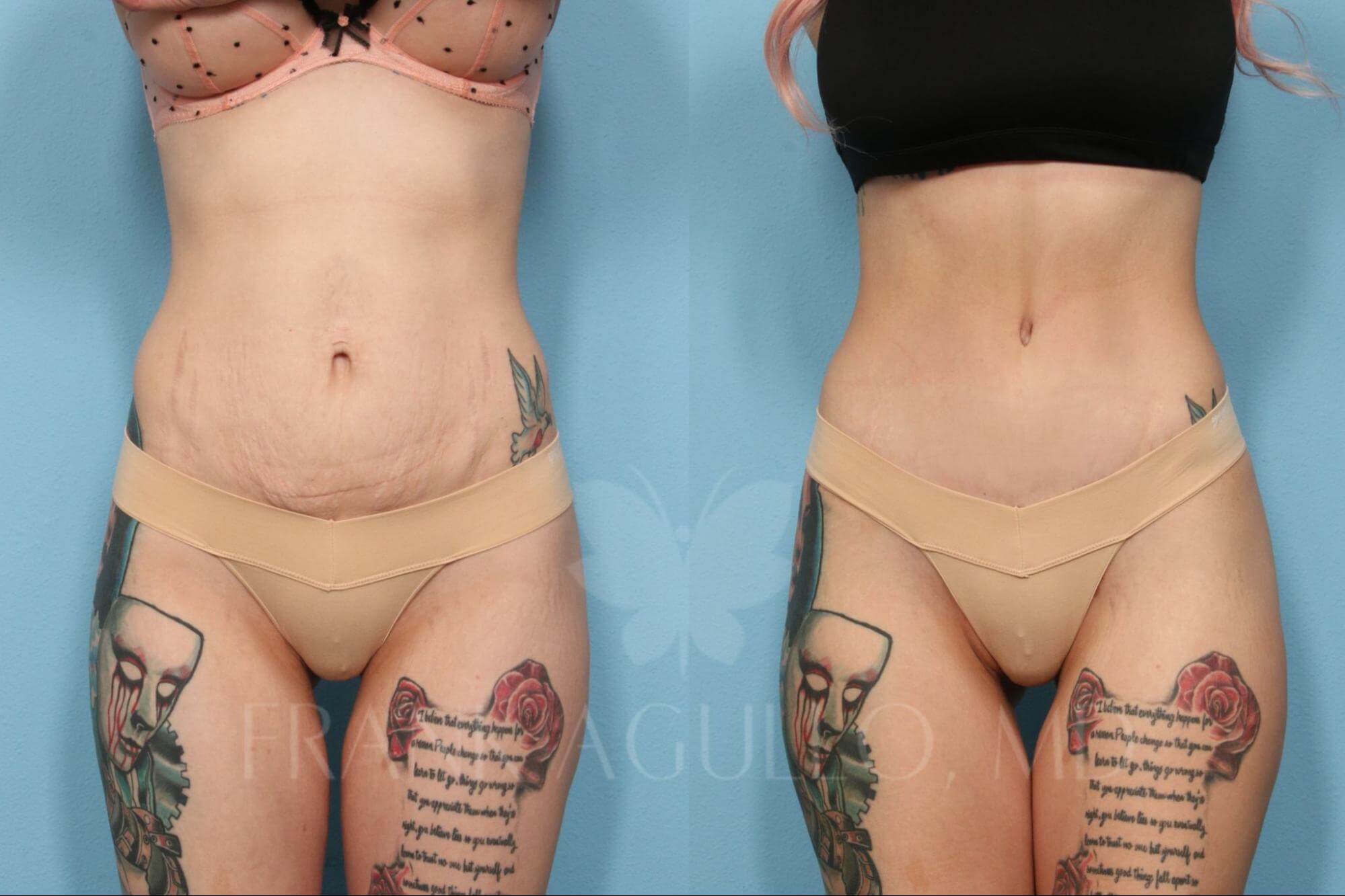 Is Mini Tummy Tuck Better for a Fit Girl