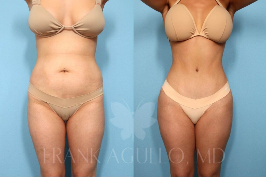 All You Need To Know About a Tummy Tuck: Before and After Photos, Video,  and More