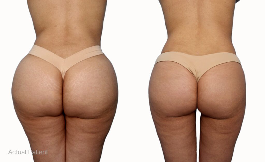 Understanding Brazilian Butt Lift Scars: What to Expect