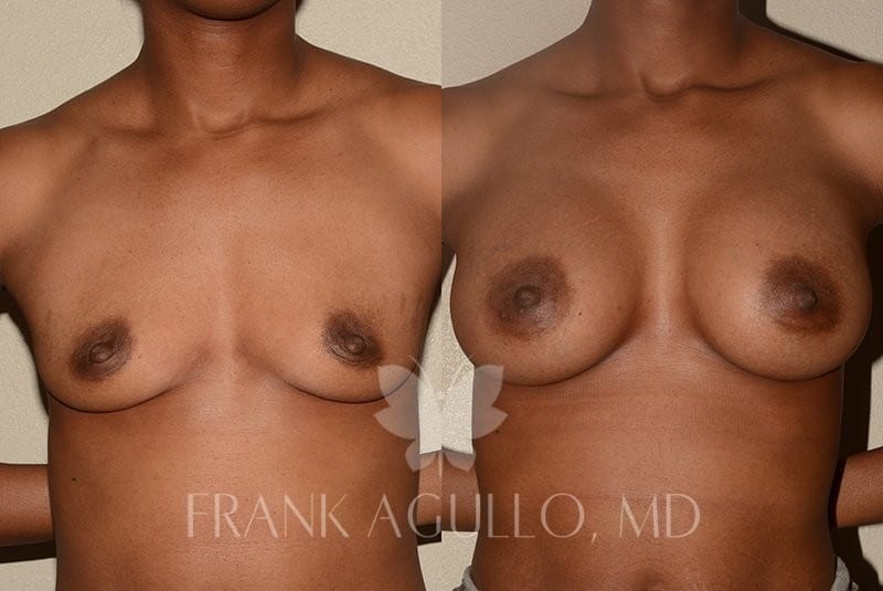 Before After Photos Breast Augmentation 16 F