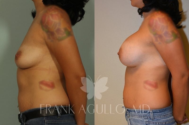 Before After Photos Breast Augmentation 21 Frank Agullo MD