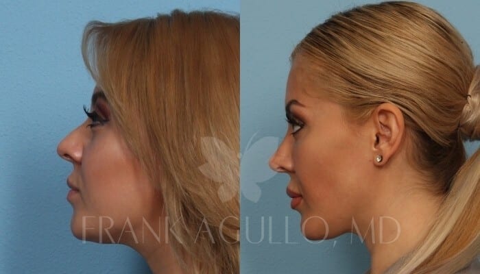 Before & After Photos  Bruccal Fat Pad Removal 1 - Frank Agullo, MD