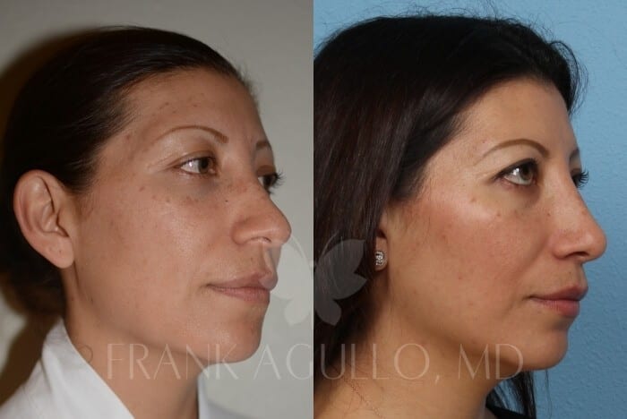 Before & After Photos | Rhinoplasty 8 - Frank Agullo, MD