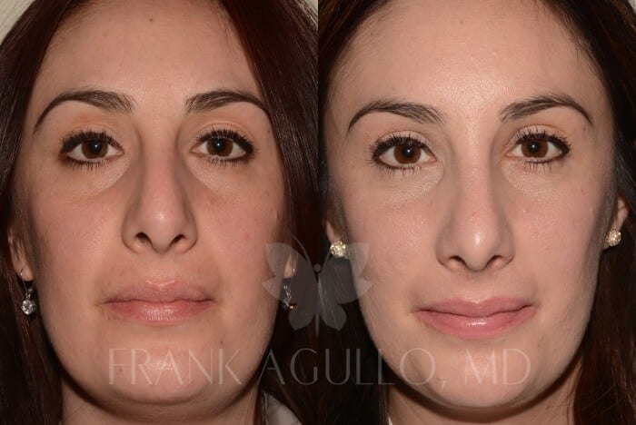 Rhinoplasty Before and After 9