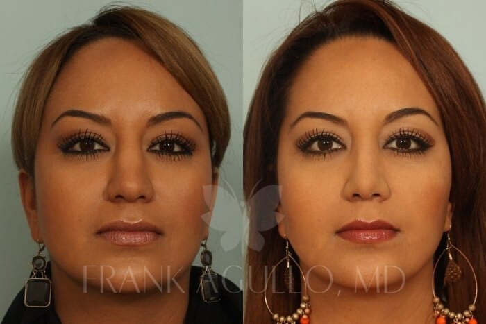 Before & After Photos | Rhinoplasty 15 - Frank Agullo, MD