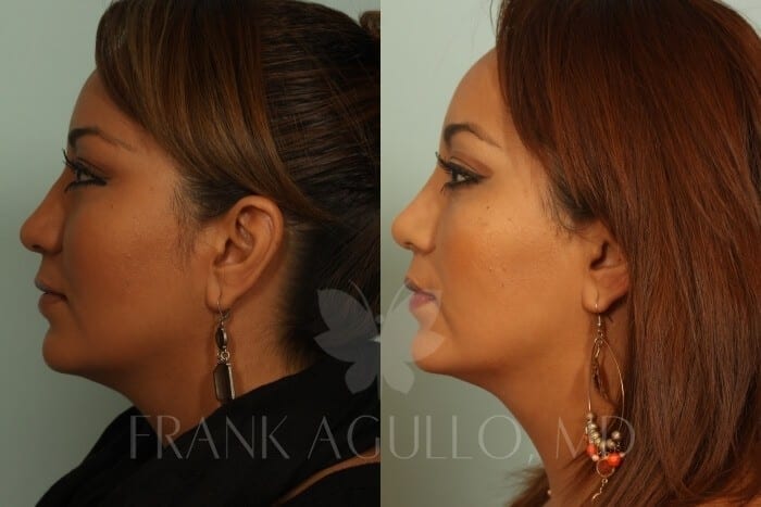 Before & After Photos | Rhinoplasty 15 - Frank Agullo, MD