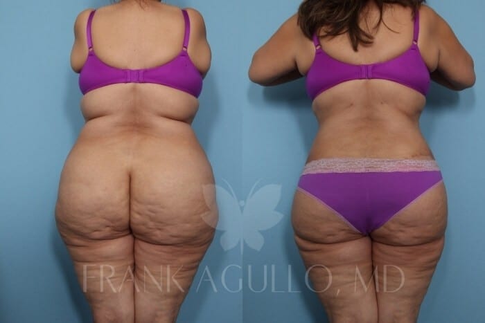 Wanting to Tone Up This Year? Learn If Tummy Tuck or Liposuction Is Right  for You - Frank Agullo, MD