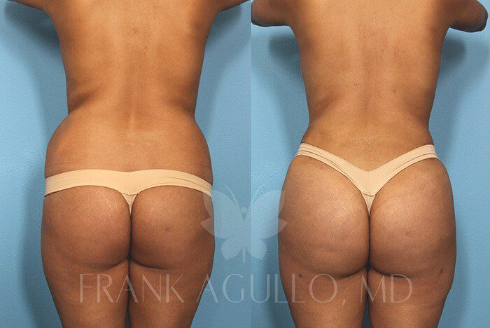 Before & After Photos  Brazilian Butt Lift Patient 42 - Frank Agullo, MD