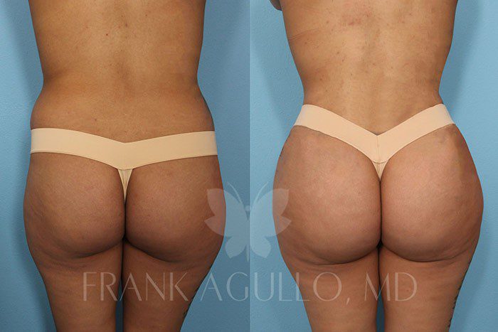 Before & After Photos  Brazilian Butt Lift 37 - Frank Agullo, MD