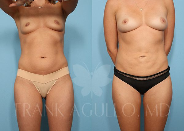 Before & After Photos  Breast Augmentation with Fat Injection