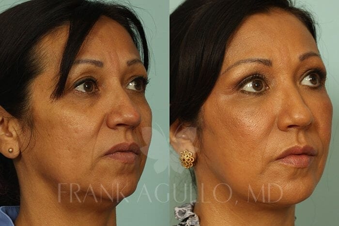 Before & After Photos | Face Lift 5 - Frank Agullo, MD