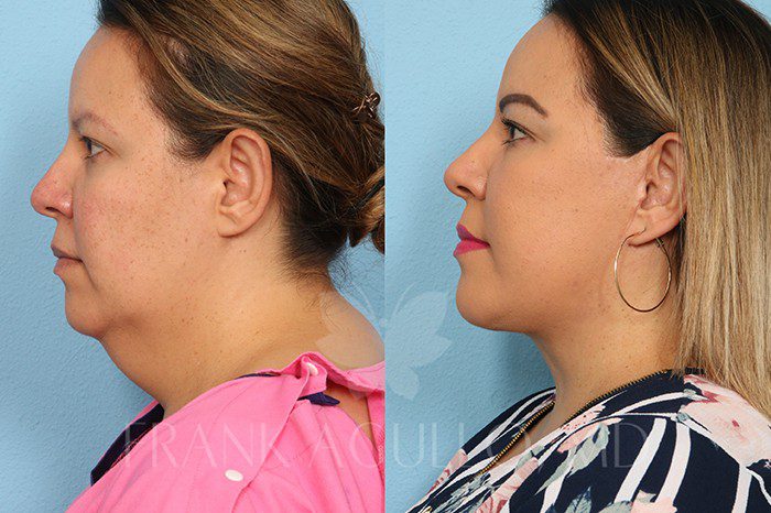 Neck Lift Surgery El Paso TX Frank Agullo MD