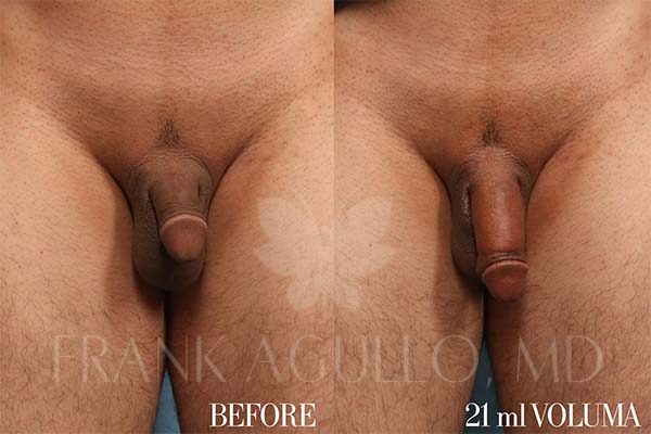 Before & After Photos  Penis Enlargement Patient 08 - Frank Agullo, MD