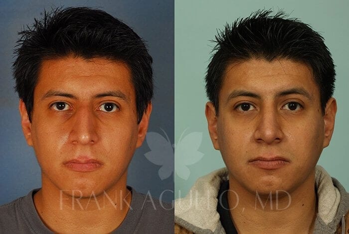 Before & After Photos | Rhinoplasty 7 - Frank Agullo, MD